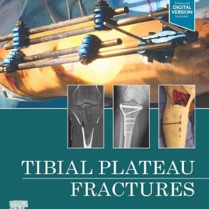 Tibial Plateau Fractures (Original PDF from Publisher)
