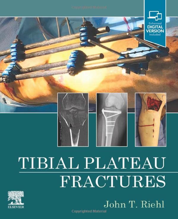 Tibial Plateau Fractures (Original PDF from Publisher)