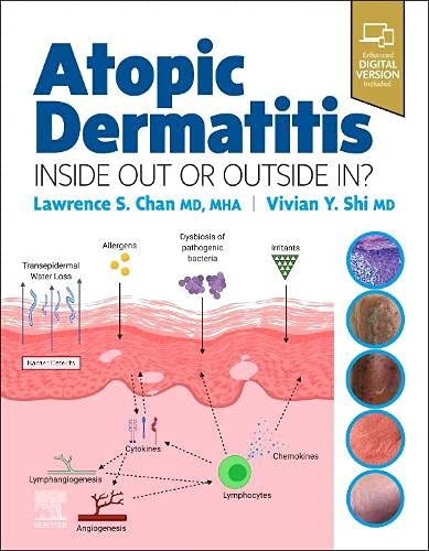 Atopic Dermatitis: Inside Out or Outside In (Original PDF from Publisher)