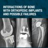 Interactions of Bone with Orthopedic Implants and Possible Failures (Original PDF from Publisher)