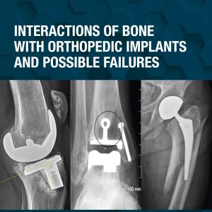 Interactions of Bone with Orthopedic Implants and Possible Failures (Original PDF from Publisher)