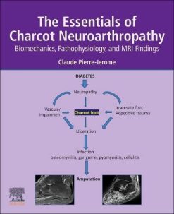 The Essentials of Charcot Neuroarthropathy: Biomechanics, Pathophysiology, and MRI Findings (Original PDF from Publisher)