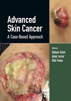 Advanced Skin Cancer: A Case-Based Approach (Original PDF from Publisher)