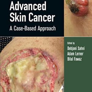 Advanced Skin Cancer: A Case-Based Approach (Original PDF from Publisher)