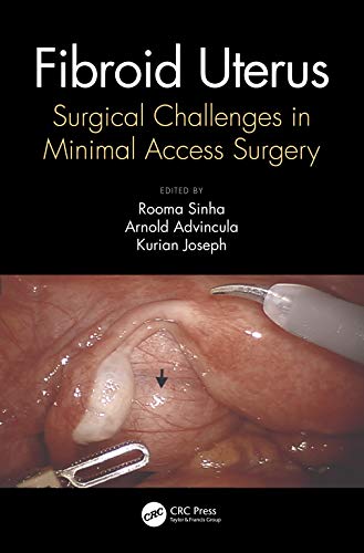 Fibroid Uterus: Surgical Challenges in Minimal Access Surgery (Original PDF from Publisher)
