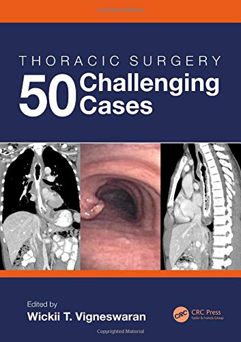 Thoracic Surgery: 50 Challenging cases (Original PDF from Publisher)