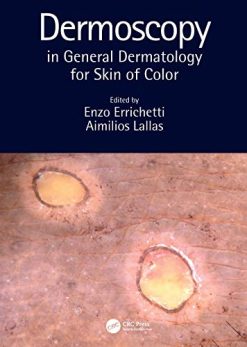 Dermoscopy in General Dermatology for Skin of Color (Original PDF from Publisher)