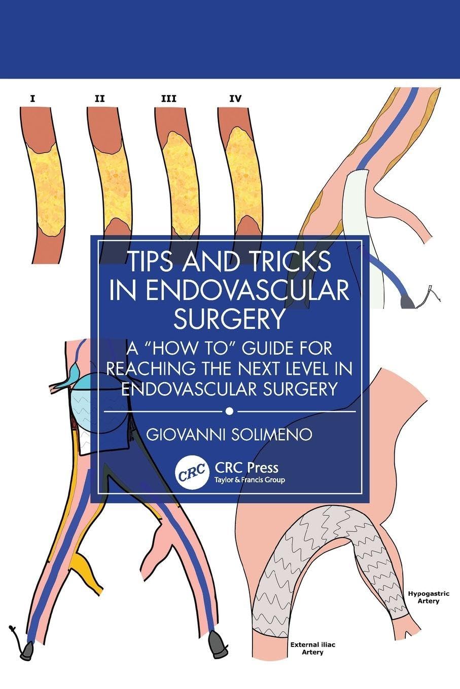 Tips and Tricks in Endovascular Surgery: A “How to” Guide for reaching the next Level in Endovascular Surgery (EPUB)
