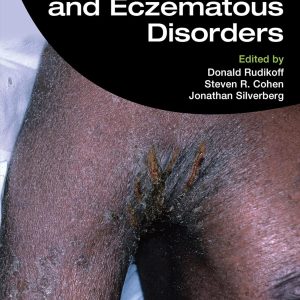 Atopic Dermatitis and Eczematous Disorders, 2nd Edition (EPUB)