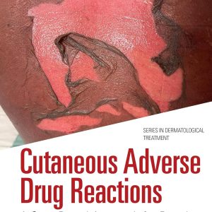 Cutaneous Adverse Drug Reactions: A Case Based Approach for Deeply Pigmented Skin (Series in Dermatological Treatment) (Original PDF from Publisher)