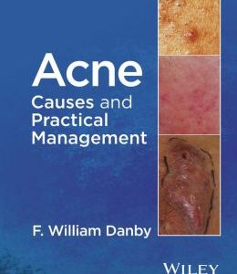 Acne: Causes and Practical Management