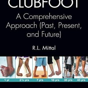 Clubfoot: A Comprehensive Approach (Past, Present, and Future) (PDF)