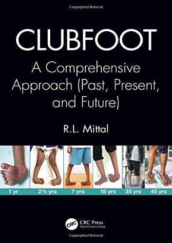 Clubfoot: A Comprehensive Approach (Past, Present, and Future) (PDF)
