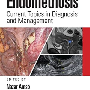 Endometriosis: Current Topics in Diagnosis and Management (Original PDF from Publisher)