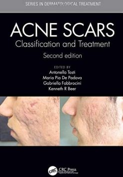 Acne Scars: Classification and Treatment, 2ed (PDF)