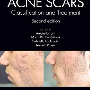 Acne Scars: Classification and Treatment, 2ed (PDF)