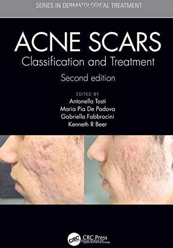 Acne Scars: Classification and Treatment, 2ed (PDF)