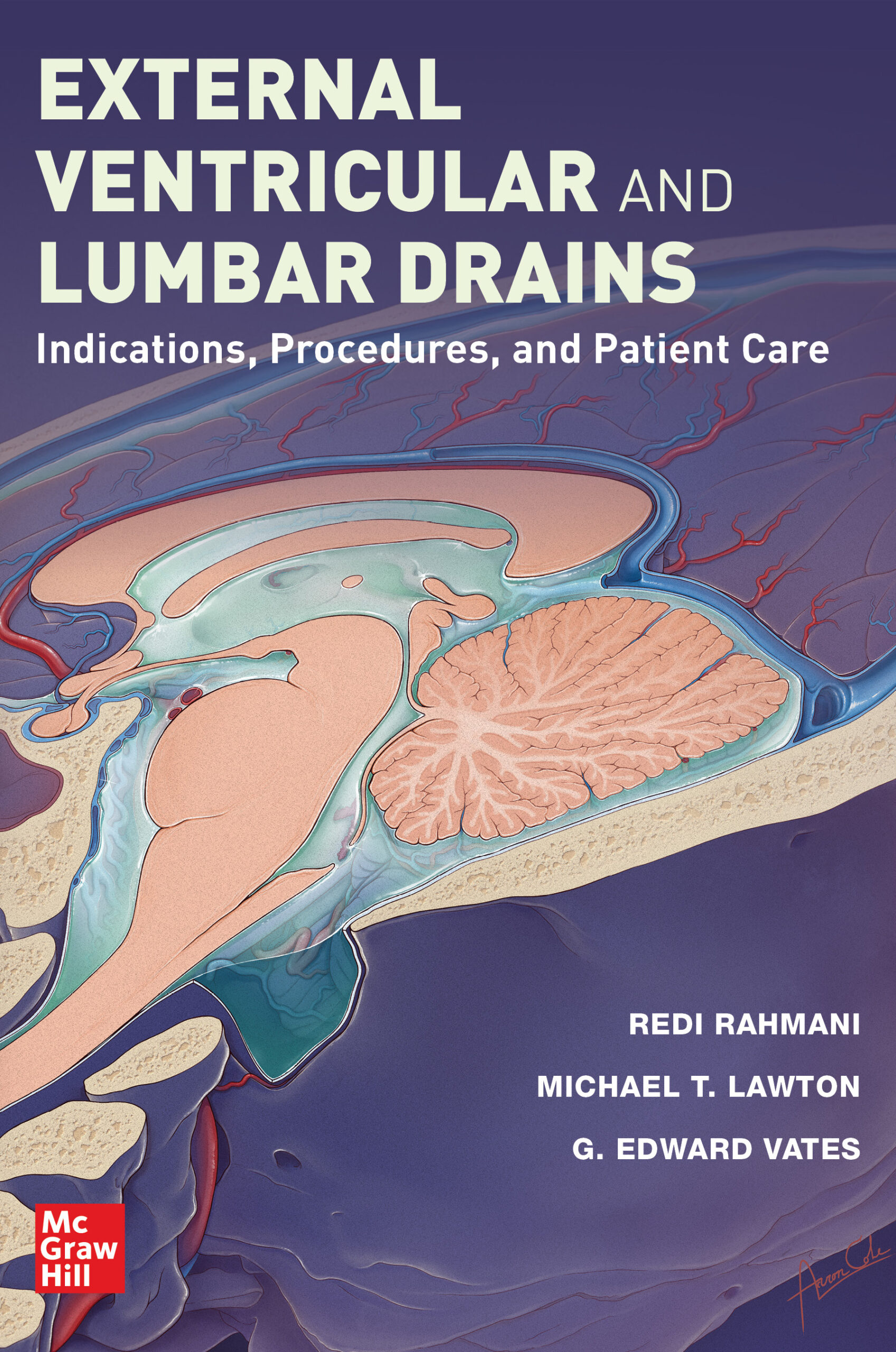 External Ventricular and Lumbar Drains: Indications, Procedures, and Patient Care (Original PDF from Publisher)