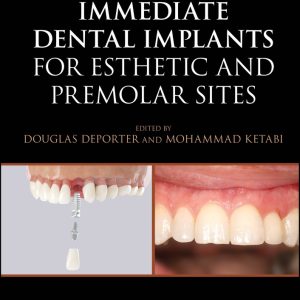 Immediate Dental Implants for Esthetic and Premolar Sites (EPUB)