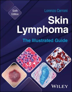 Skin Lymphoma: The Illustrated Guide, 6th Edition (EPUB)