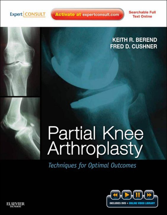 Partial Knee Arthroplasty: Techniques for Optimal Outcomes (Original PDF from Publisher)