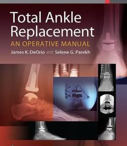 Total Ankle Replacement: An Operative Manual (ORIGINAL PDF from Publisher)