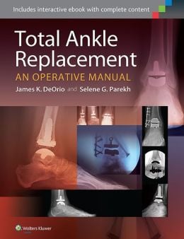 Total Ankle Replacement: An Operative Manual (ORIGINAL PDF from Publisher)