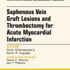 Saphenous Vein Graft Lesions and Thrombectomy for Acute Myocardial Infarction, An Issue of Interventional Cardiology Clinics (The Clinics: Internal Medicine) (Original PDF from Publisher)