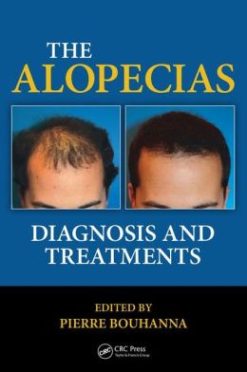 The Alopecias: Diagnosis and Treatments (Original PDF from Publisher)
