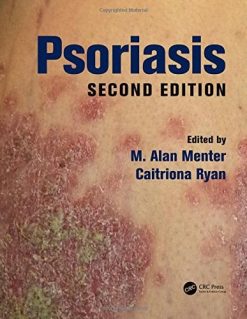 Psoriasis, Second Edition (PDF)