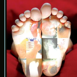 Diabetic Foot Management at the Primary Care Level (Original PDF from Publisher)