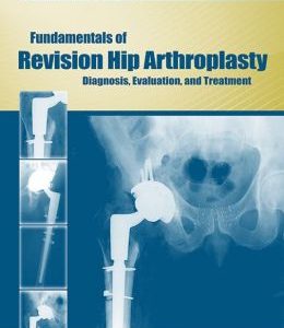 Fundamentals of Revision Hip Arthroplasty: Diagnosis, Evaluation, and Treatment