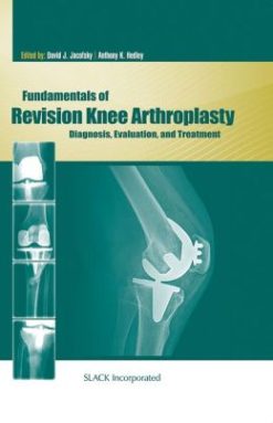 Fundamentals of Revision Knee Arthroplasty: Diagnosis, Evaluation, and Treatment (ORIGINAL PDF from Publisher)