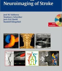 Neurosonology and Neuroimaging of Stroke