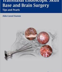 Transnasal Endoscopic Skull Base and Brain Surgery: Tips and Pearls (ORIGINAL PDF from Publisher)