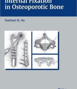 Internal Fixation in Osteoporotic Bone