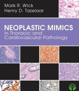 Neoplastic Mimics in Thoracic and Cardiovascular Pathology