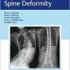 Neuromuscular Spine Deformity, 1st edition (EPUB)