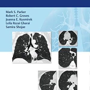 Lung Cancer Screening (PDF)