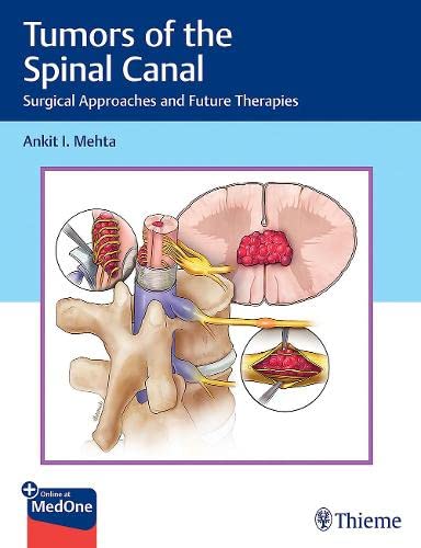 Tumors of the Spinal Canal: Surgical Approaches and Future Therapies (Original PDF from Publisher)