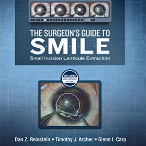 The Surgeon’s Guide to SMILE: Small Incision Lenticule Extraction (PDF)