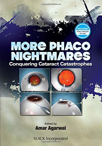 More Phaco Nightmares: Conquering Cataract Catastrophes (EPUB)