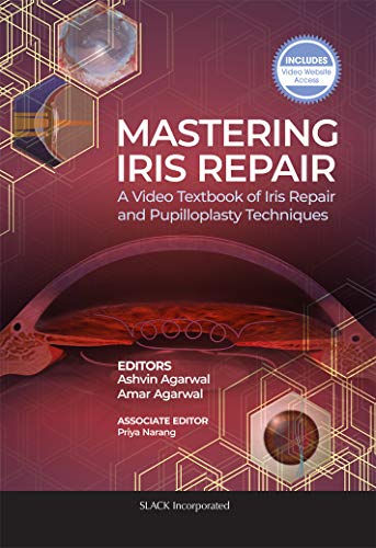 Mastering Iris Repair: A Video Textbook of Iris Repair and Pupilloplasty Techniques (Original PDF from Publisher)