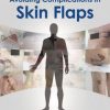 Making Decisions and Avoiding Complications in Skin Flaps