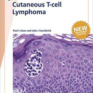 Fast Facts: Cutaneous T-cell Lymphoma (Original PDF from Publisher)