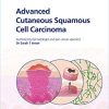 Fast Facts: Advanced Cutaneous Squamous Cell Carcinoma for Patients and their Supporters: Information + Taking Control = Best Outcome (Original PDF from Publisher)