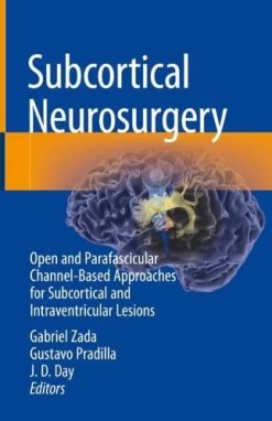 Subcortical Neurosurgery: Open and Parafascicular Channel-Based Approaches for Subcortical and Intraventricular Lesions (Original PDF from Publisher)