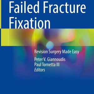 Failed Fracture Fixation (Original PDF from Publisher)