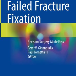 Failed Fracture Fixation (EPUB)