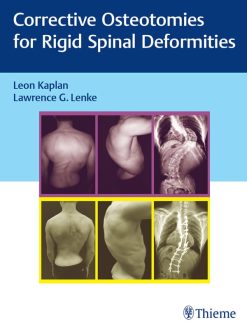 Corrective Osteotomies for Rigid Spinal Deformities (EPUB)